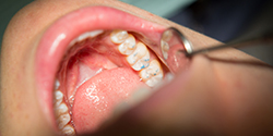 Close up of patient's teeth during dental exam