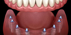 a 3D illustration of implant dentures