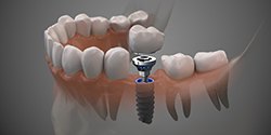 single dental implant supporting a crown 
