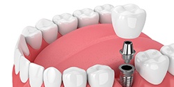 dental crown being placed on top of a dental implant