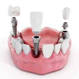 Model showing each part of a dental implant